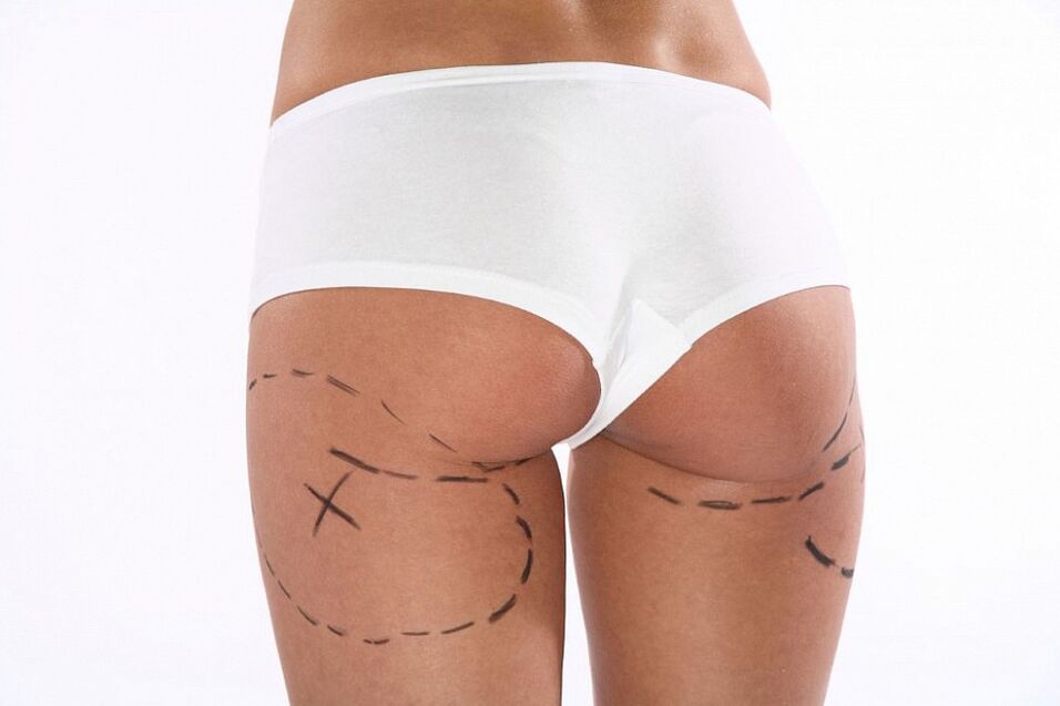 Cosmetic procedures for weight loss